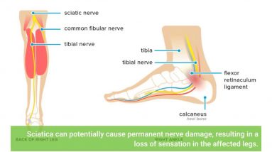 Examine This Report on Sciatic Nerve Pain Treatment & Doctor - Zaker Chiropractic