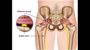 The smart Trick of Best Ways to Treat Sciatica Pain - Colorado Pain Care That Nobody is Discuss...