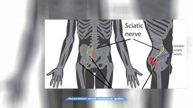 The Basic Principles Of Sciatica l Spine Services l University Hospitals l Cleveland