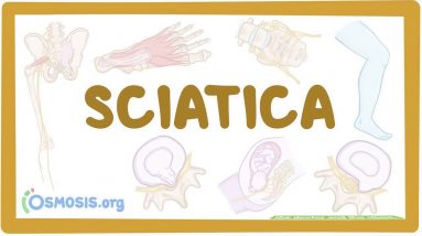How Sciatica: Causes, Symptoms, Treatment, Prevention & Pain can Save You Time, Stress, and Mon...