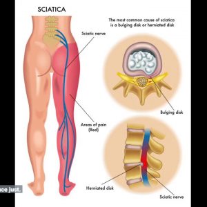 Fascination About Do I Have Sciatica? 10 Of The Most Common Sciatica