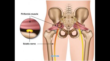 The Definitive Guide to Sciatica Exercises for Piriformis Syndrome Video - Spine-health