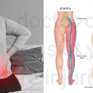 Indicators on When to Consider Sciatica Surgery? You Should Know