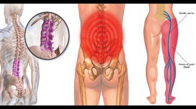 Not known Incorrect Statements About Is Your Back Pain Sciatica? - OnHealth