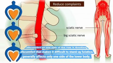 The Best Guide To Sciatica Treatment - Florida Orthopaedic Institute