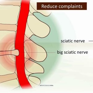 Little Known Questions About The 5 Natural Ways to Relieve Sciatica - StFrancis Sports.