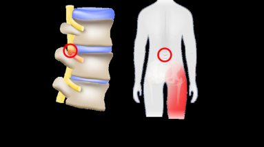 The Main Principles Of Sciatica: Sciatic Nerve Location, Treatment, Causes & Pain